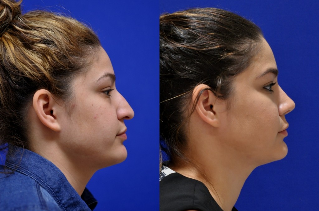 KM Rhinoplasty Right Lateral