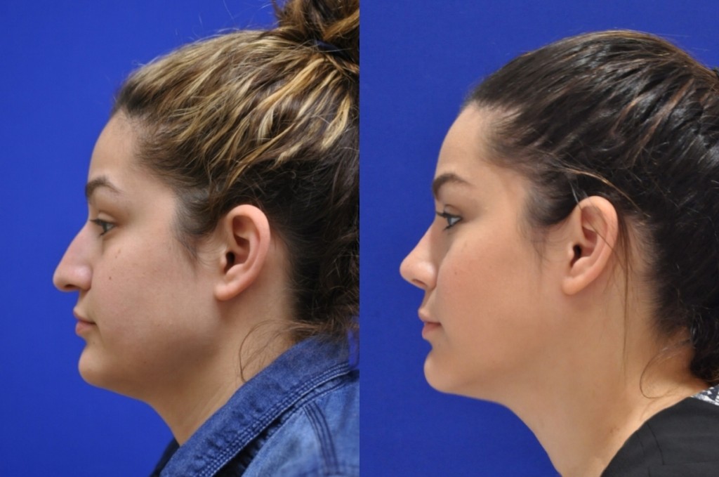 KM Rhinoplasty Left Lateral