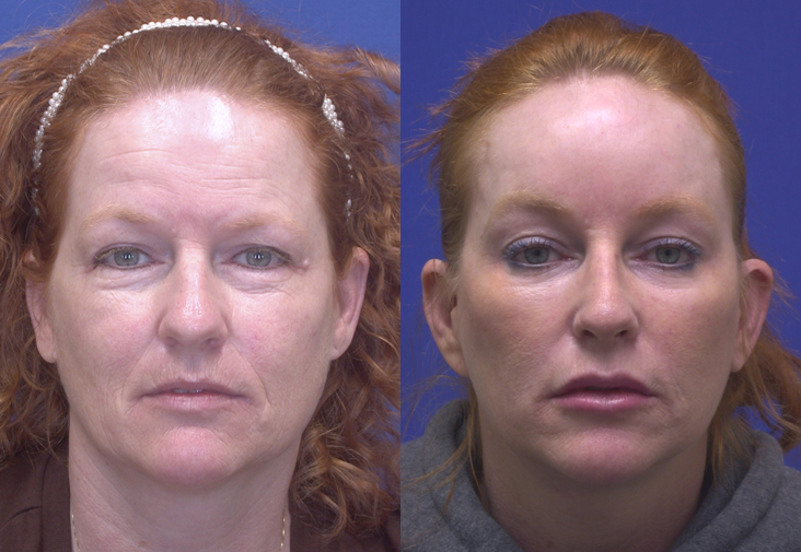 Frontal surg / non-surg