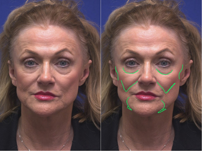 Aging Face