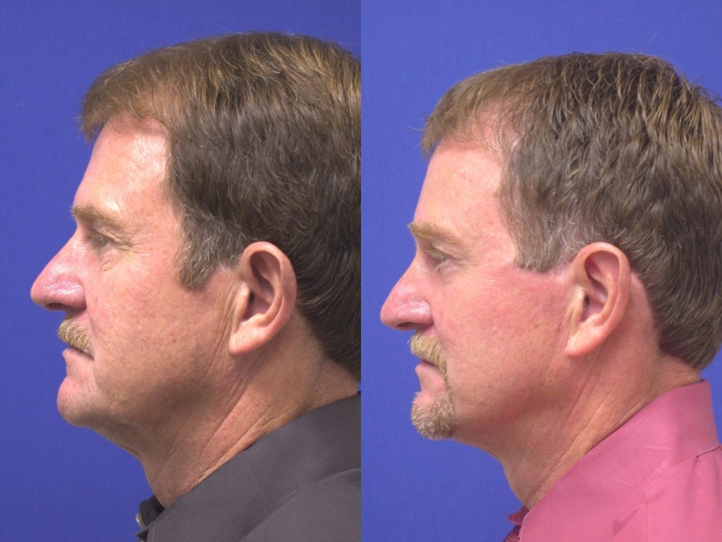 Oblique RR AM surg/nonsurg