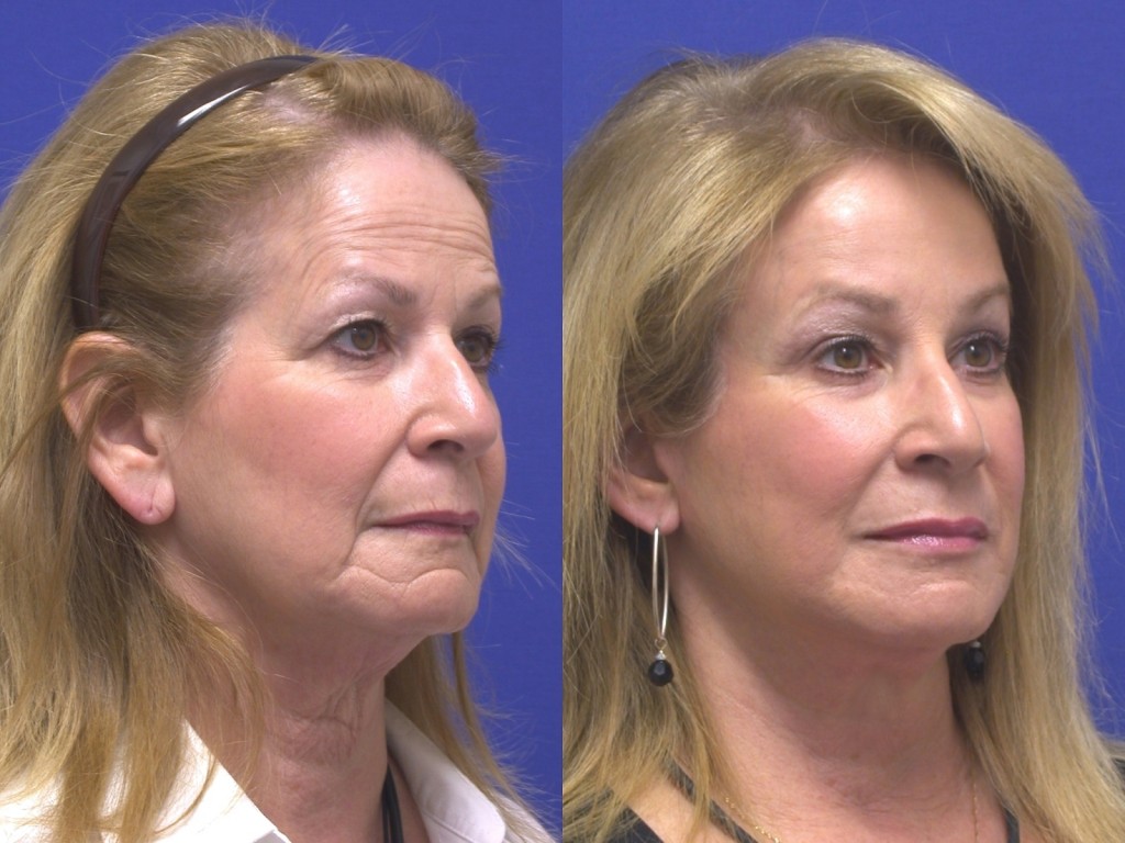 Oblique RR LM surg/nonsurg