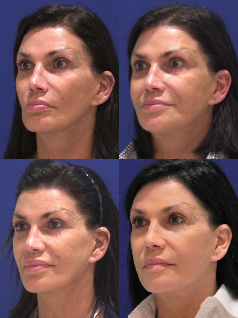 SculptraAesthetic Oblique series